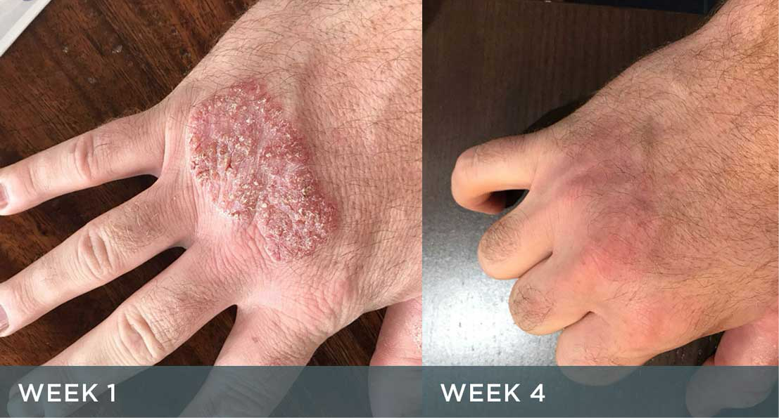 Eczema silicon Gloves