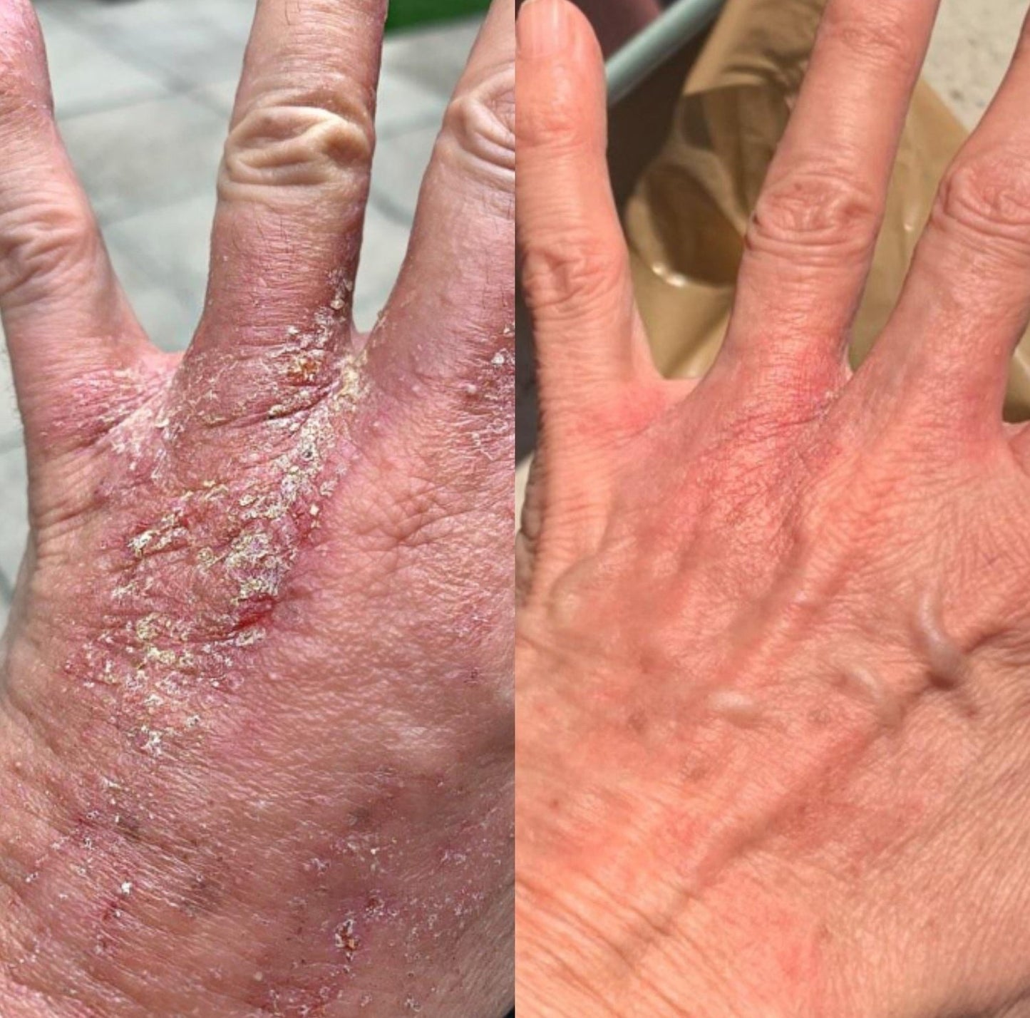 Eczema silicon Gloves