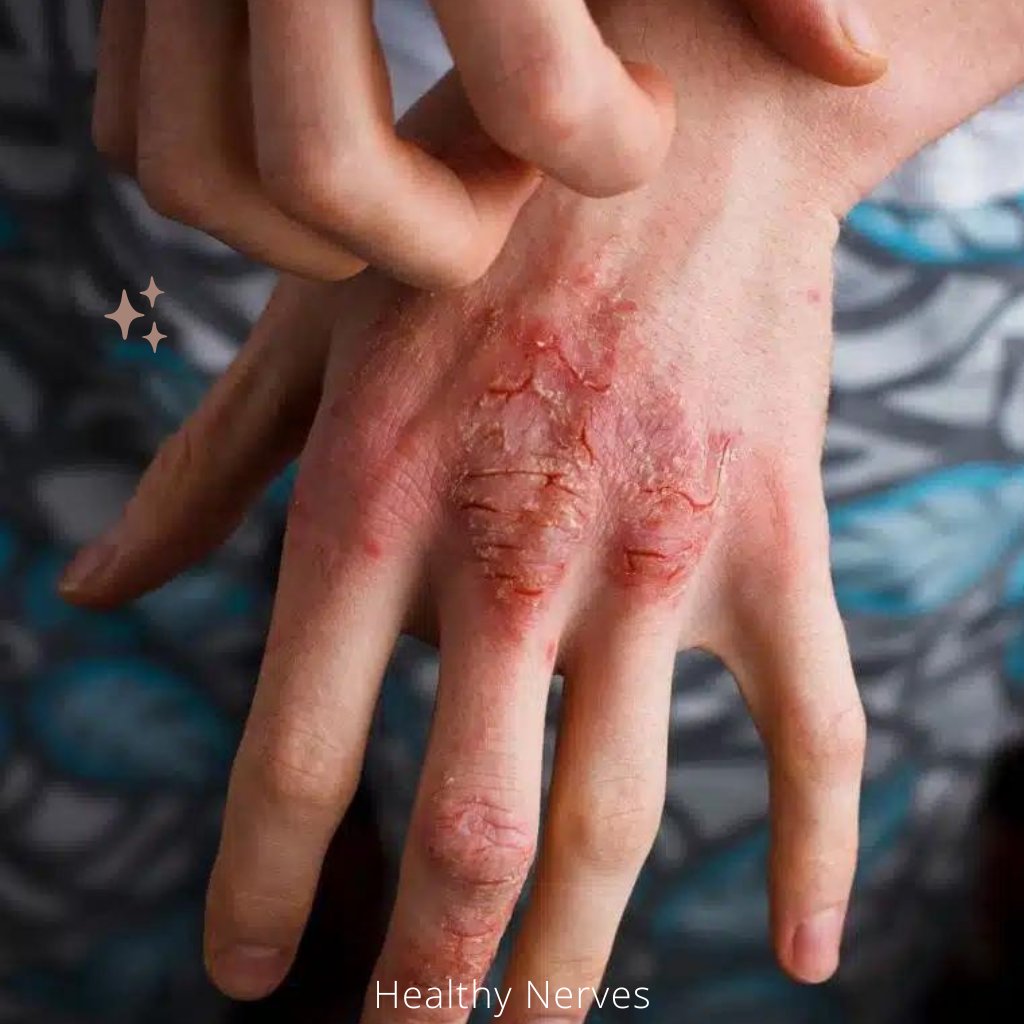 Eczema treatment