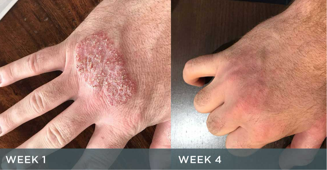 Eczema silicon Gloves