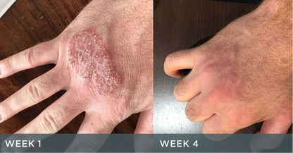 Eczema silicon Gloves