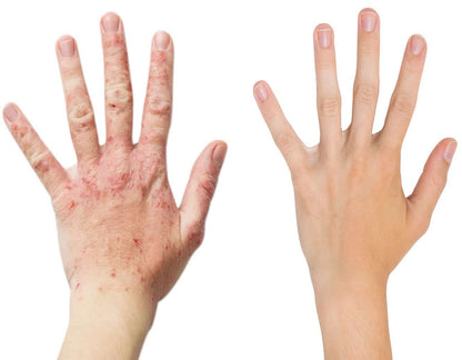 Eczema silicon Gloves